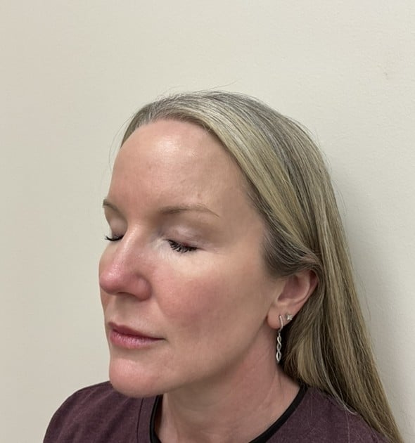 Laser skin resurfacing after photo, right oblique view — Case 97, Cool Springs Plastic Surgery, Brentwood TN