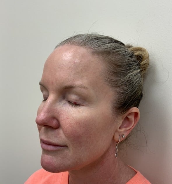 Laser skin resurfacing before photo, right oblique view — Case 97, Cool Springs Plastic Surgery, Brentwood TN