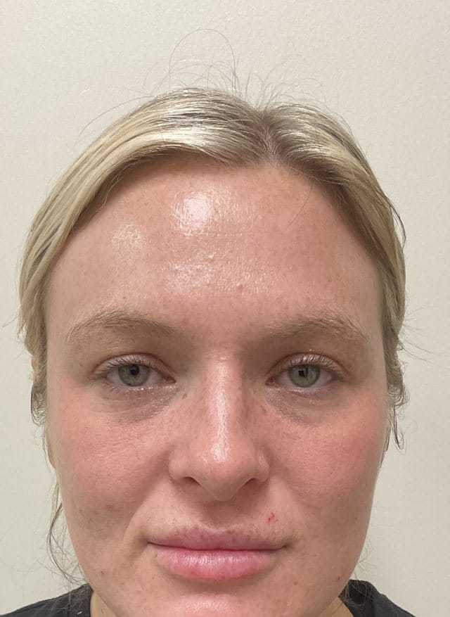 Laser skin treatment (BBL + Moxi) after photo, frontal view — Case 100, Cool Springs Plastic Surgery, Brentwood TN