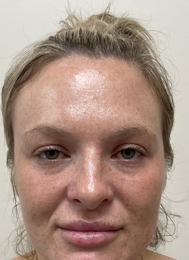 Laser skin treatment (BBL + Moxi) before photo, frontal view — Case 100, Cool Springs Plastic Surgery, Brentwood TN