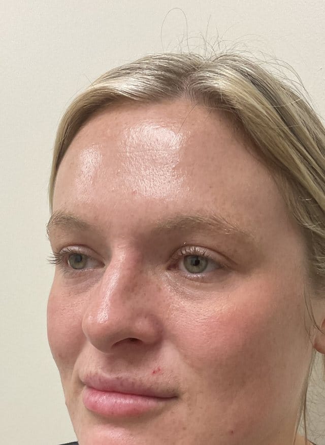 Laser skin treatment (BBL + Moxi) after photo, left oblique view — Case 100, Cool Springs Plastic Surgery, Brentwood TN