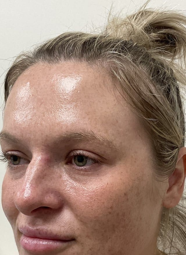 Laser skin treatment (BBL + Moxi) before photo, left oblique view — Case 100, Cool Springs Plastic Surgery, Brentwood TN