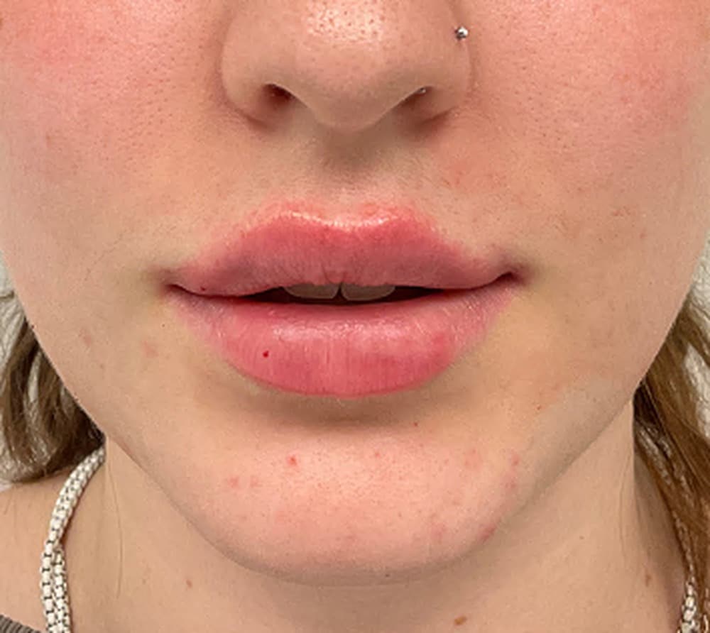Lip filler after photo — Chrissy Handly, Case 62, Cool Springs Plastic Surgery, Brentwood TN
