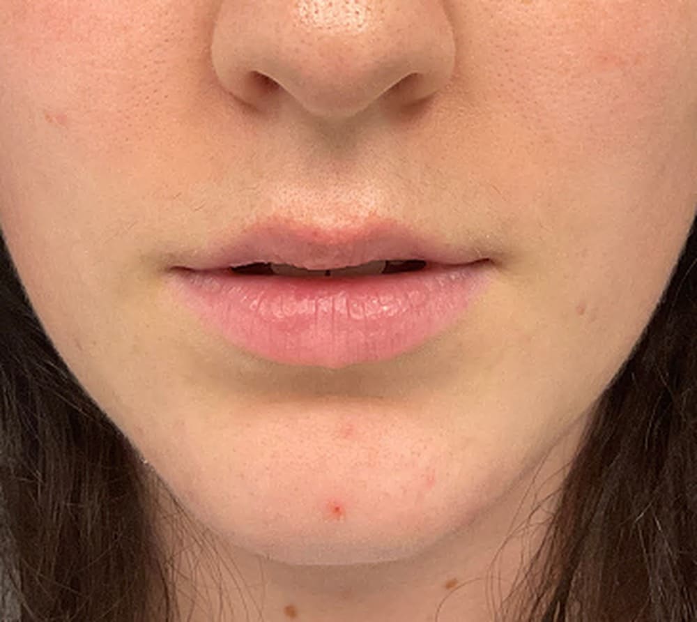 Lip filler before photo — Chrissy Handly, Case 62, Cool Springs Plastic Surgery, Brentwood TN
