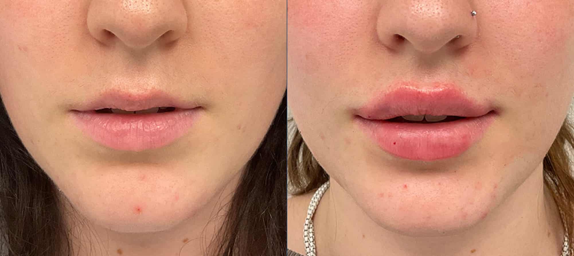 Lip filler before and after — Chrissy Handly, Case 62, Cool Springs Plastic Surgery
