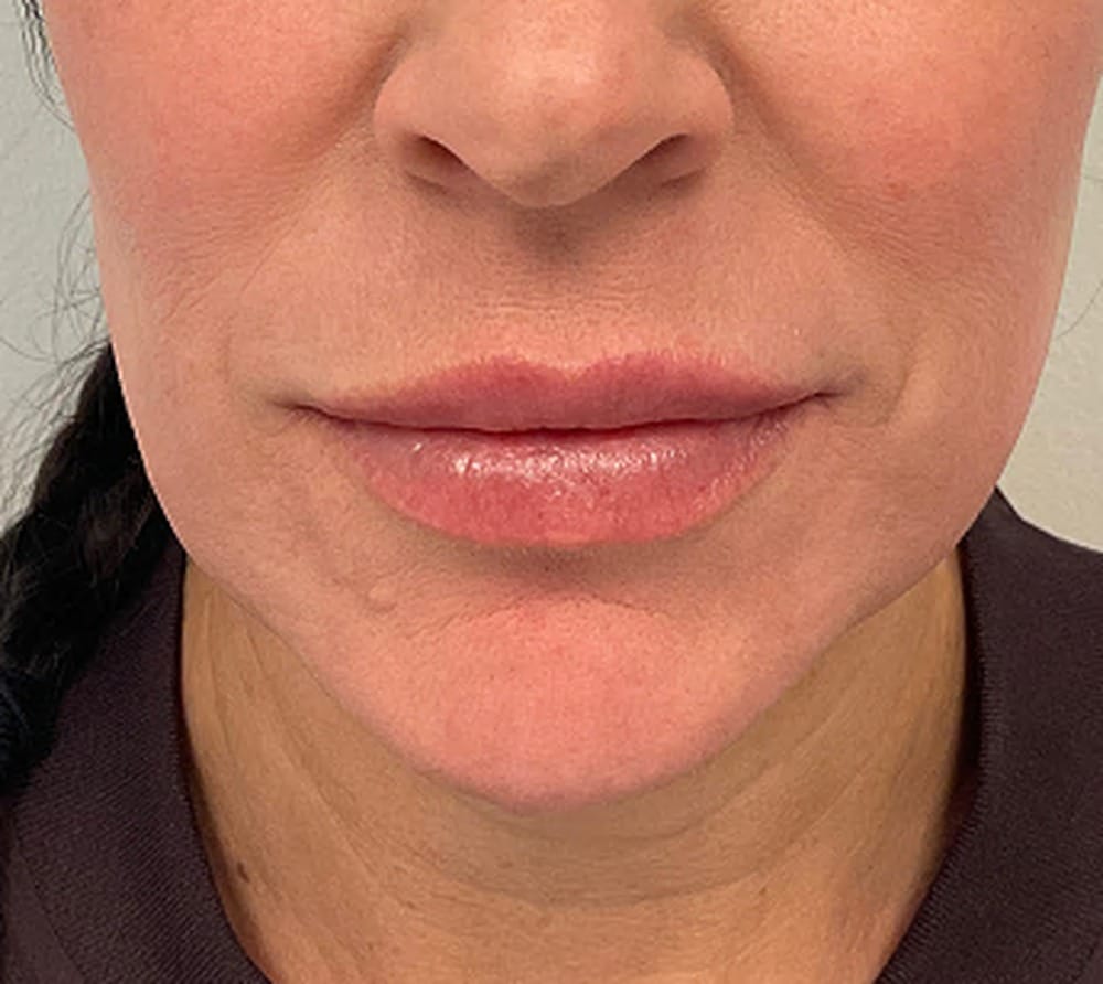 Lip filler after photo — Chrissy Handly, Case 64, Cool Springs Plastic Surgery, Brentwood TN