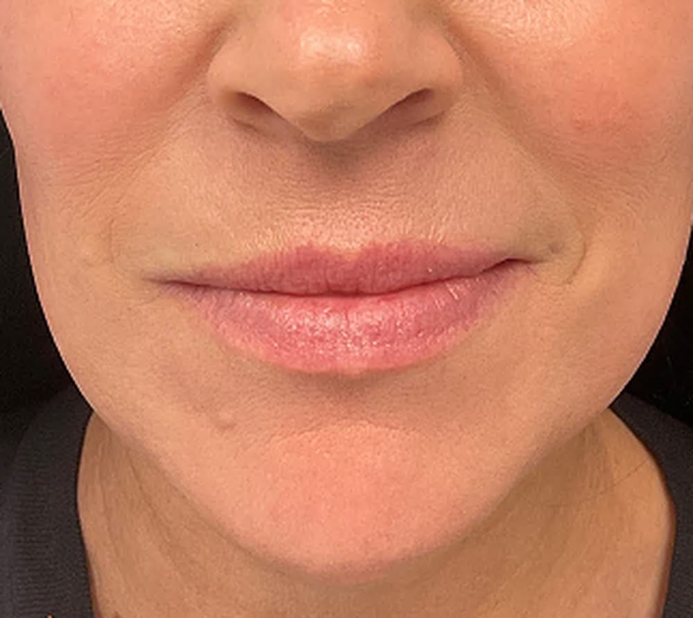 Lip filler before photo — Chrissy Handly, Case 64, Cool Springs Plastic Surgery, Brentwood TN