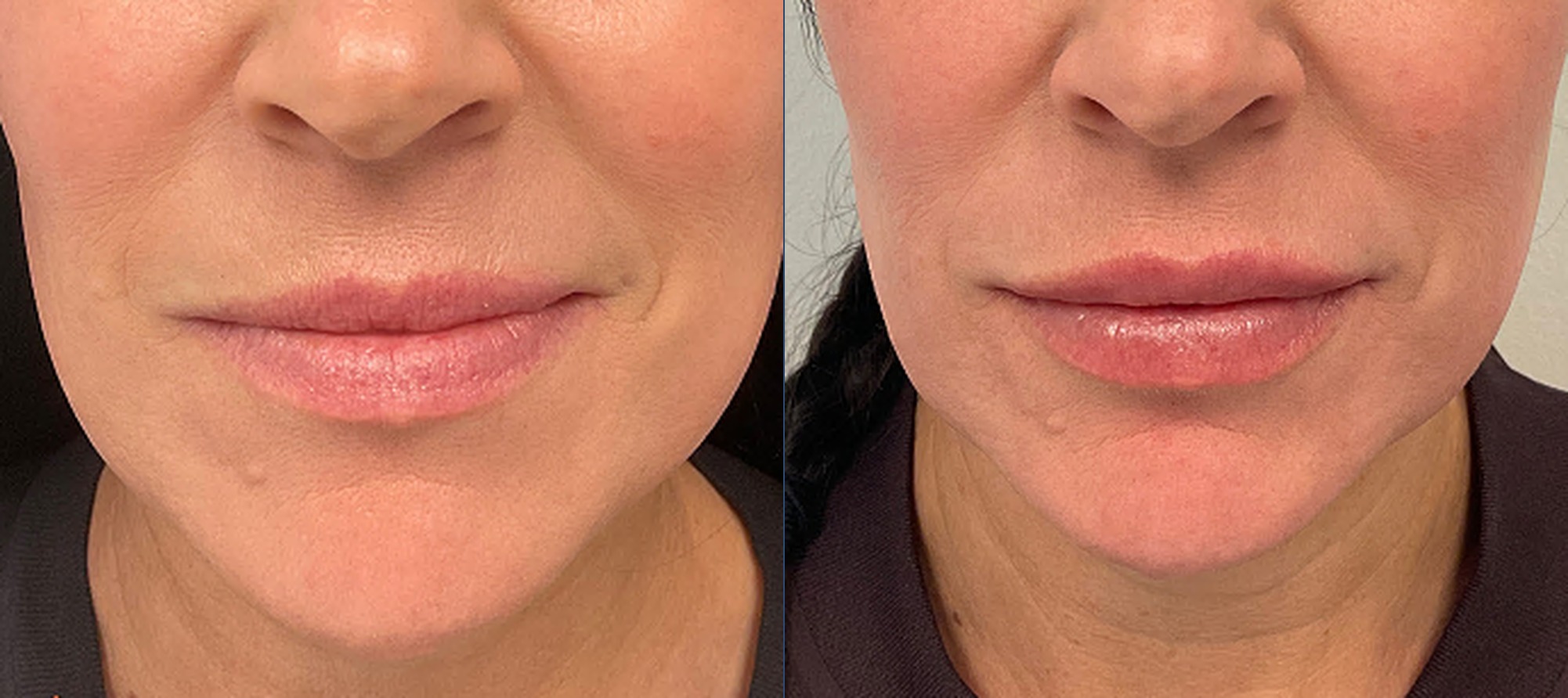 Lip filler before and after — Chrissy Handly, Case 64, Cool Springs Plastic Surgery