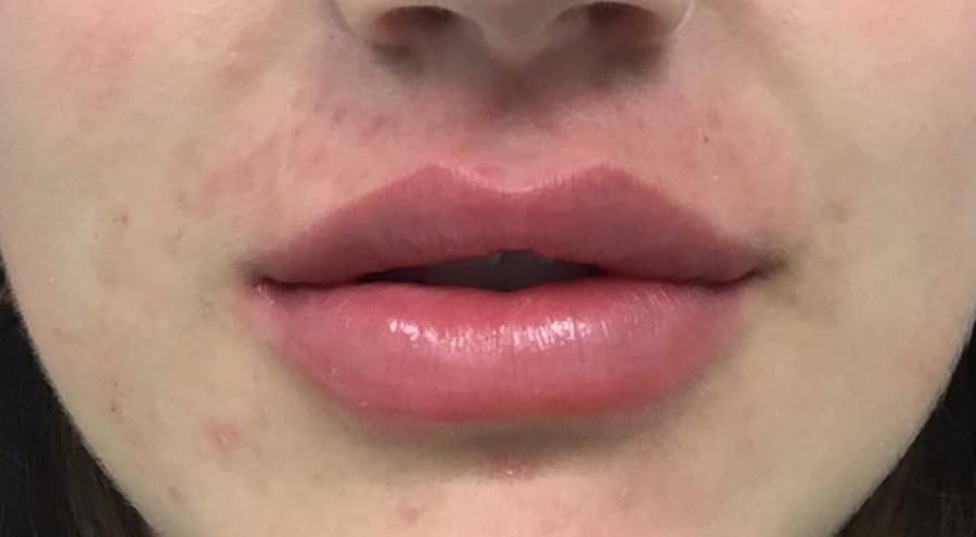Lip filler after photo — Chrissy Handly, Case 71, Cool Springs Plastic Surgery, Brentwood TN