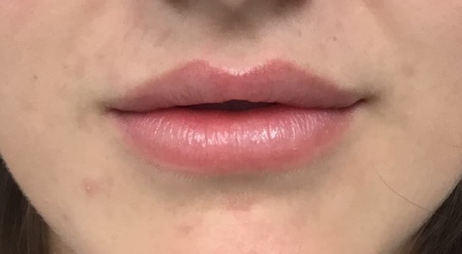 Lip filler before photo — Chrissy Handly, Case 71, Cool Springs Plastic Surgery, Brentwood TN