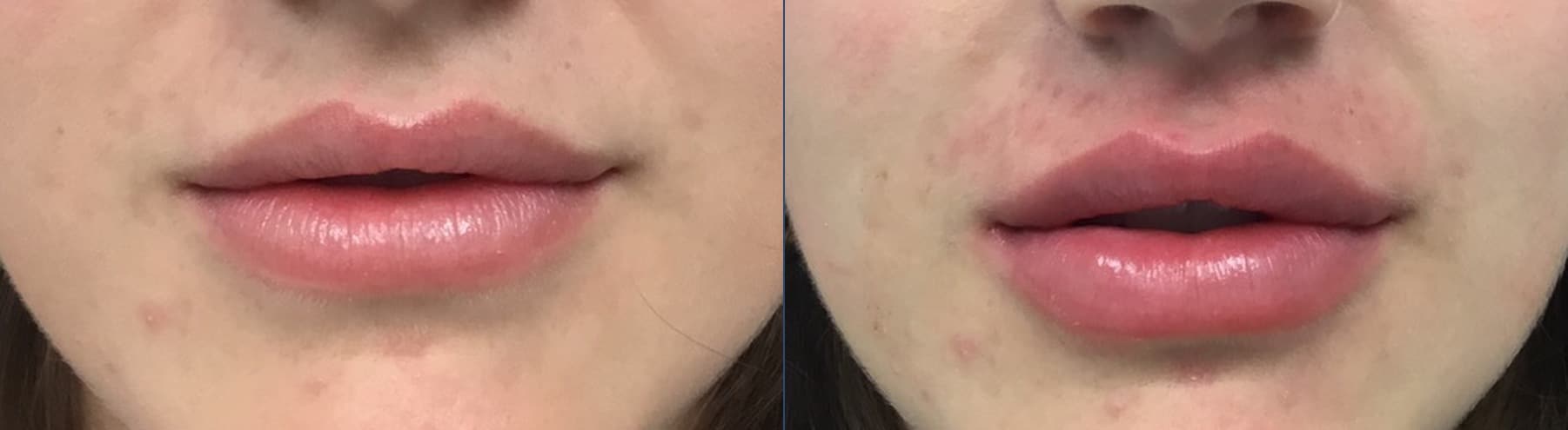 Lip filler before and after — Chrissy Handly, Case 71, Cool Springs Plastic Surgery