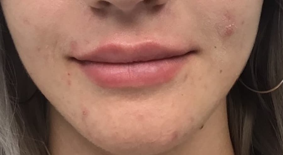 Lip filler after photo — Chrissy Handly, Case 72, Cool Springs Plastic Surgery, Brentwood TN