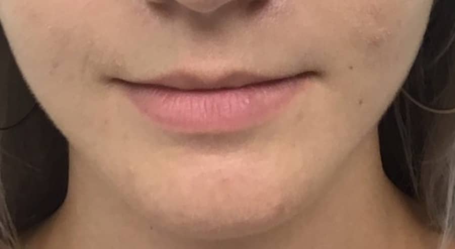 Lip filler before photo — Chrissy Handly, Case 72, Cool Springs Plastic Surgery, Brentwood TN