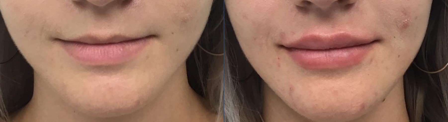 Lip filler before and after — Chrissy Handly, Case 72, Cool Springs Plastic Surgery
