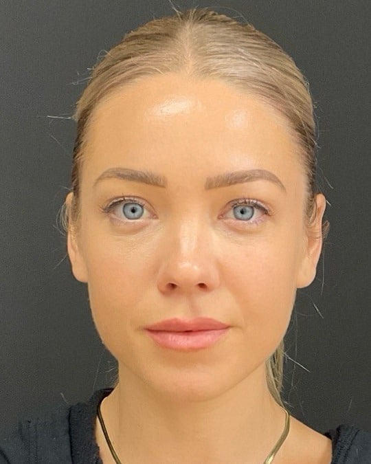 Lip filler after photo of CSPS patient — fuller lips — Brentwood TN