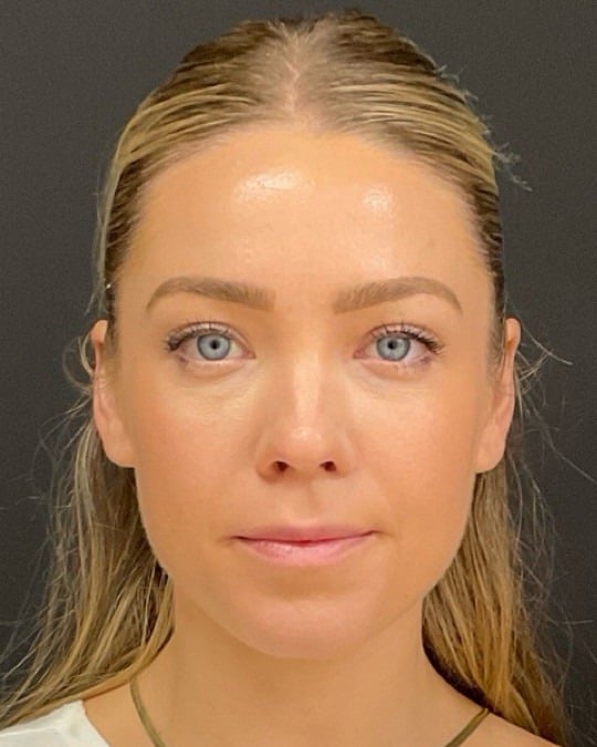Lip filler before photo of CSPS patient — thin lips — Brentwood TN