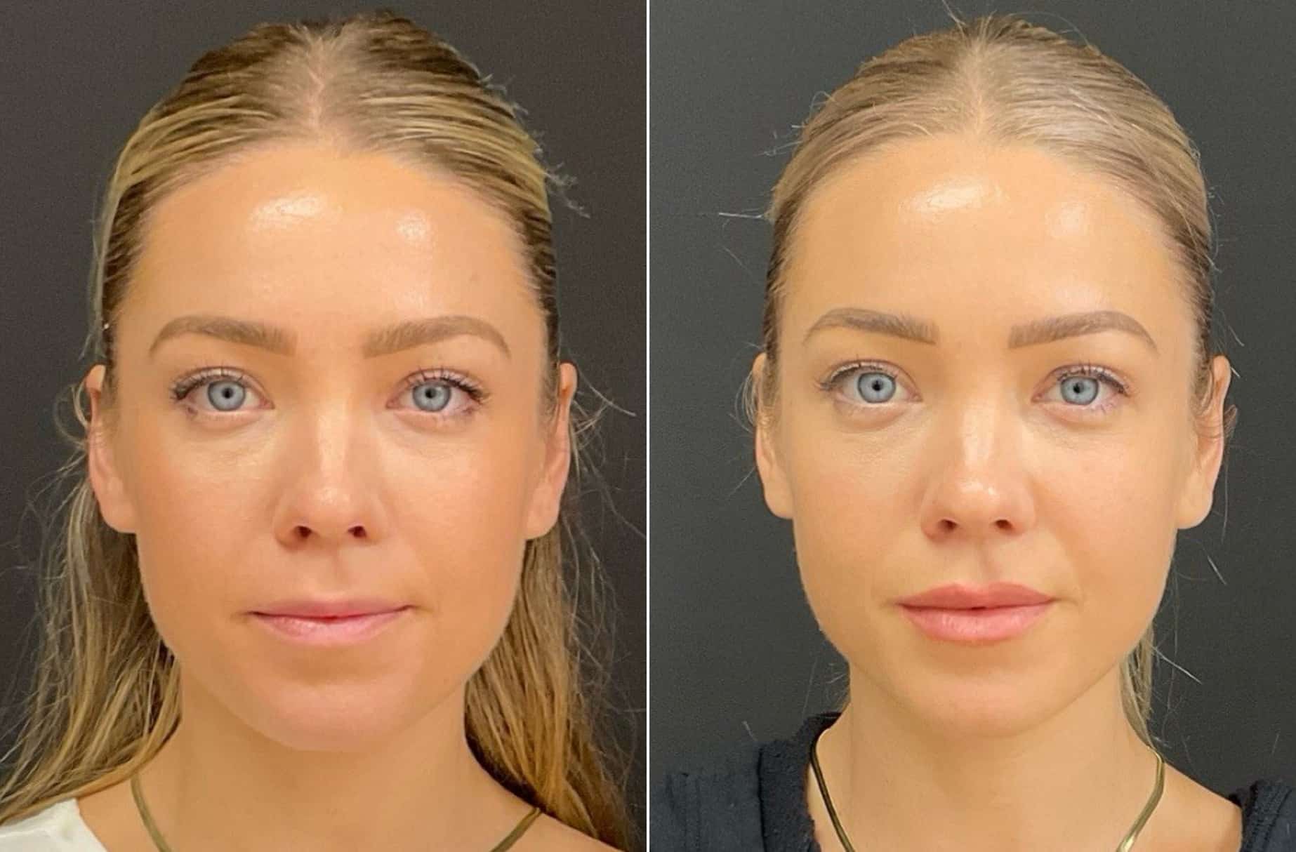 Lip filler before and after photos — CSPS patient with Kaylan Lady, FNP-C — Brentwood TN
