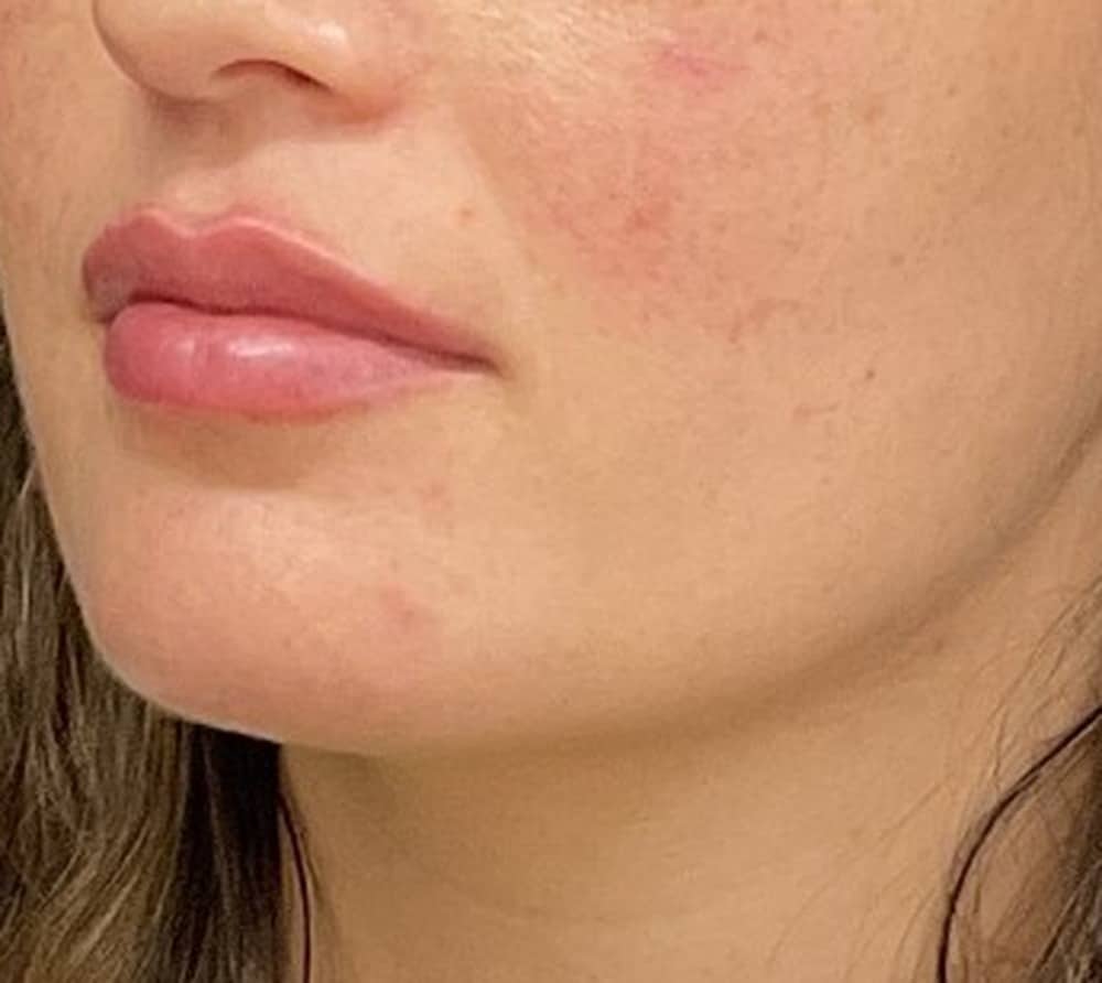 Lip filler after photo — Case 112, Cool Springs Plastic Surgery, Brentwood TN