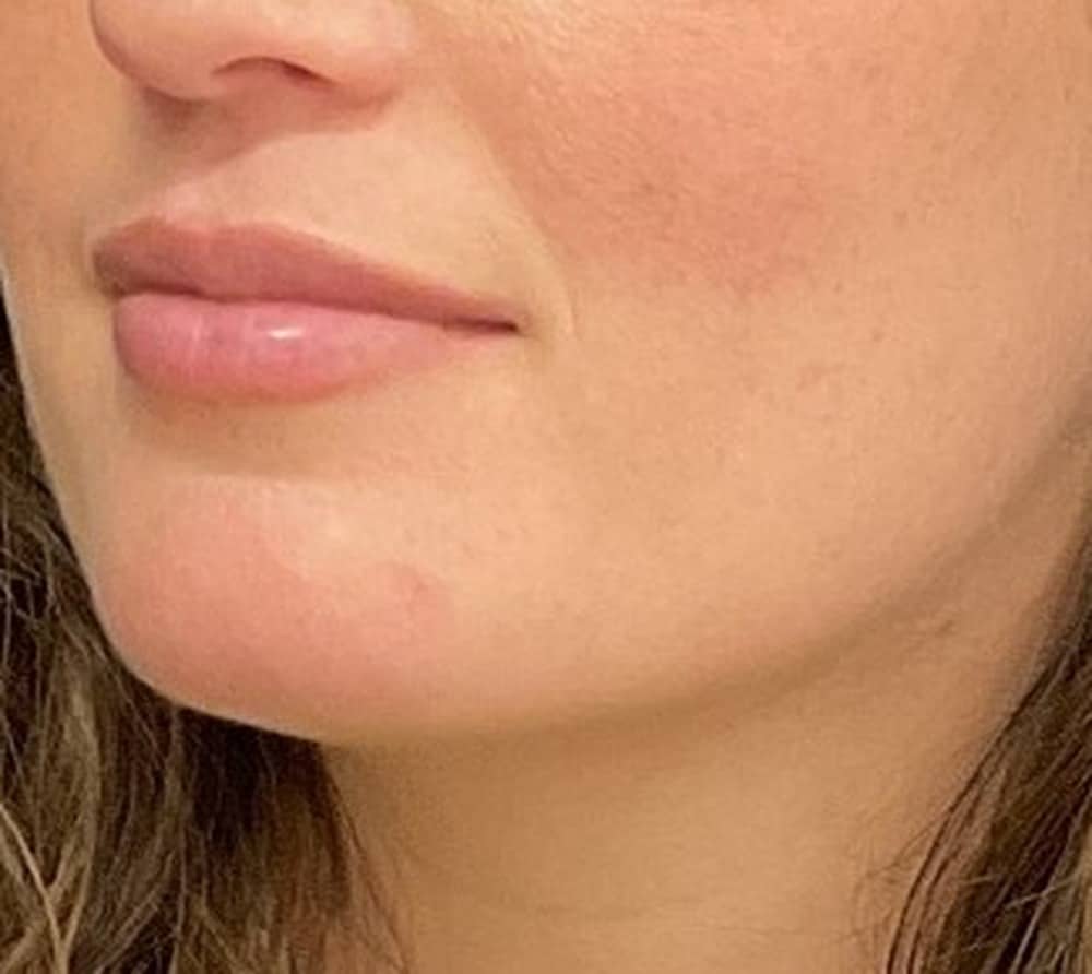 Lip filler before photo — Case 112, Cool Springs Plastic Surgery, Brentwood TN