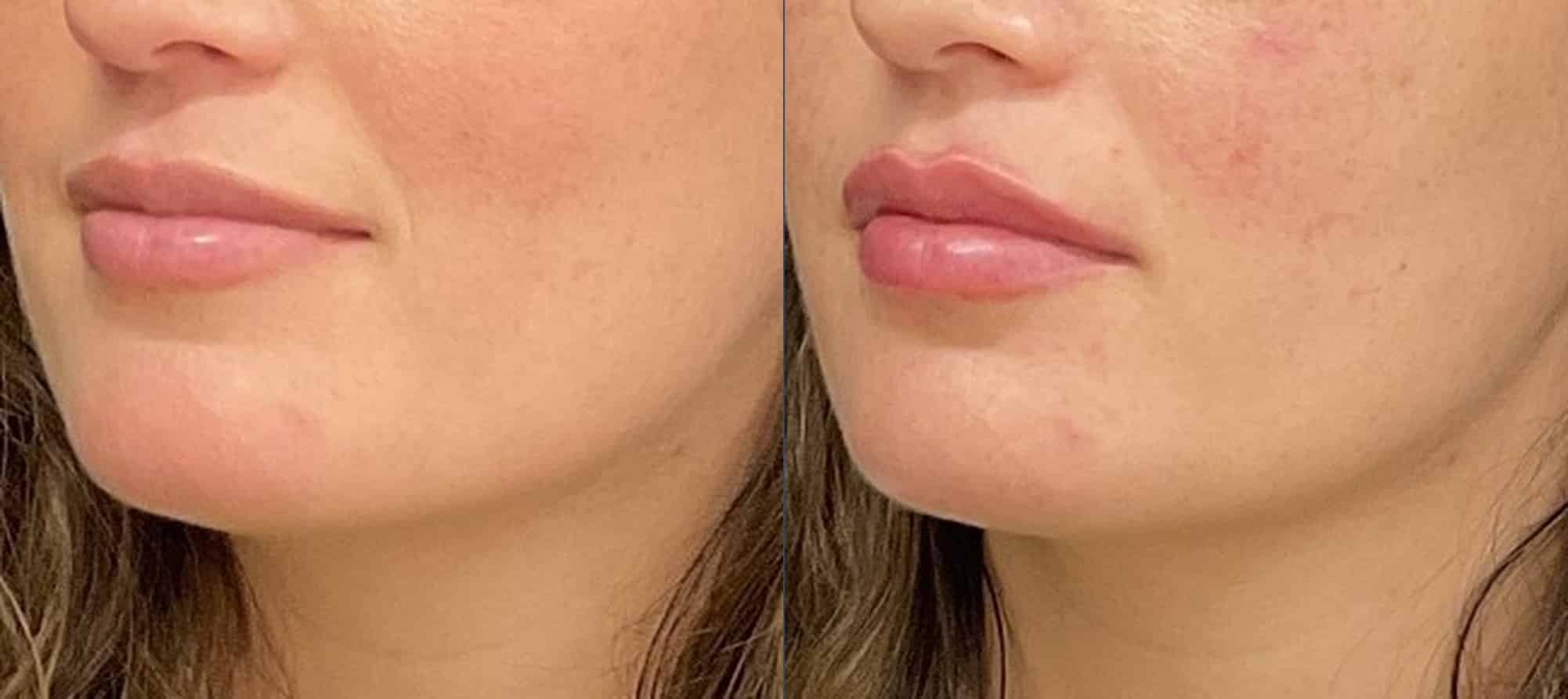 Lip filler before and after — Case 112, Cool Springs Plastic Surgery