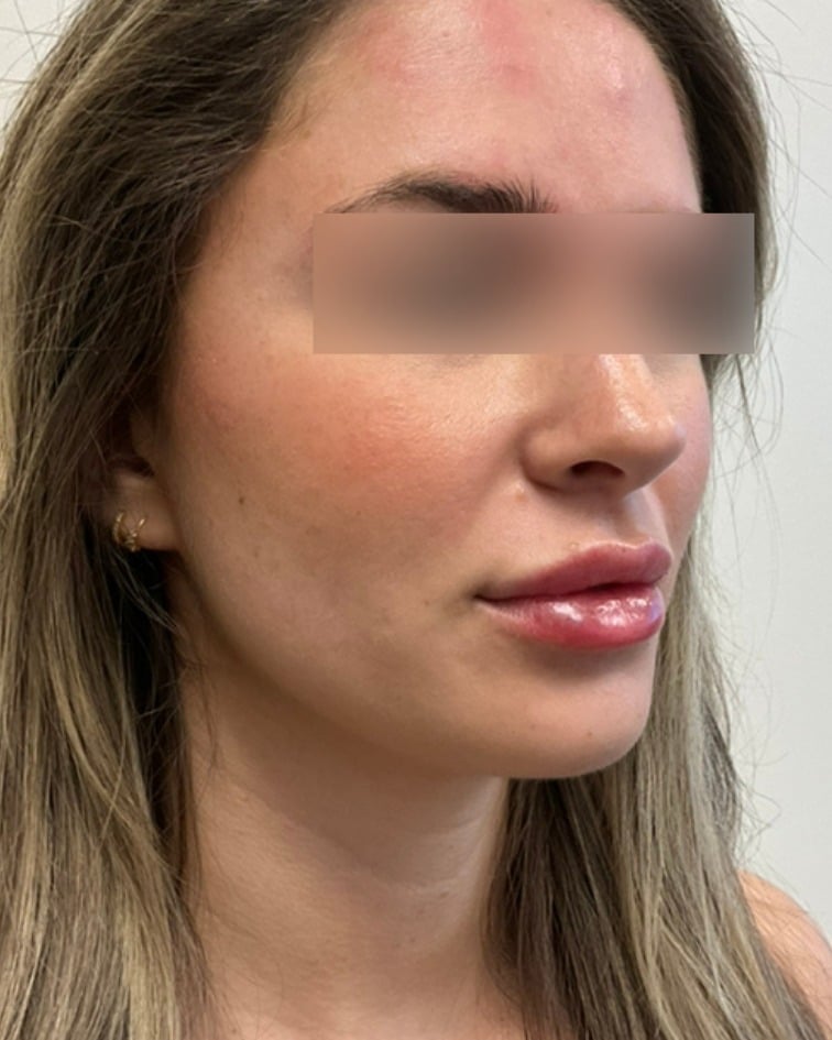 Lip filler after photo of CSPS patient — fuller lips — Brentwood TN