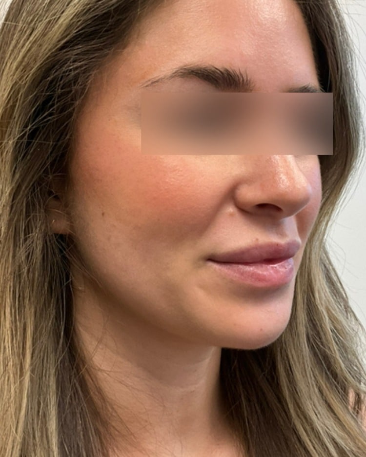 Lip filler before photo of CSPS patient — thin lips — Brentwood TN