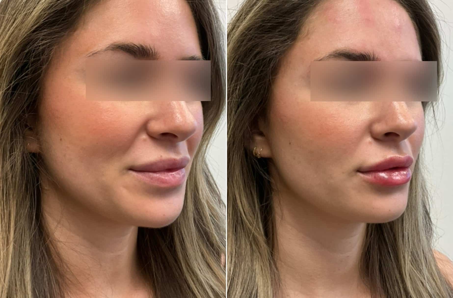 Lip filler before and after photos — CSPS patient with Laura Sonn, RN — Brentwood TN
