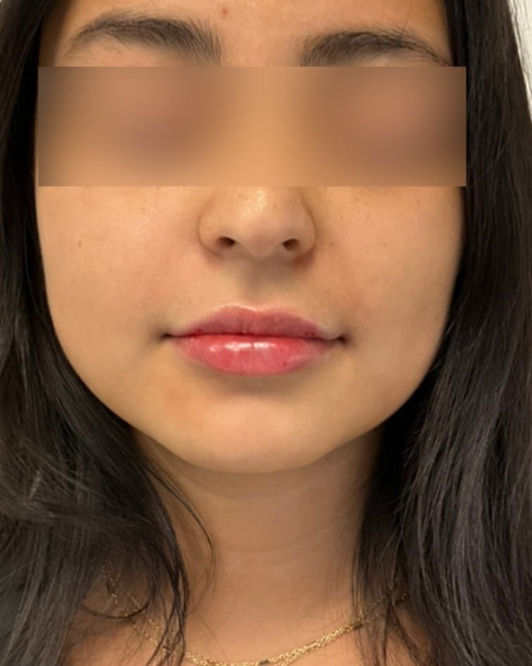 Lip filler after photo of CSPS patient — fuller, balanced lips — Brentwood TN