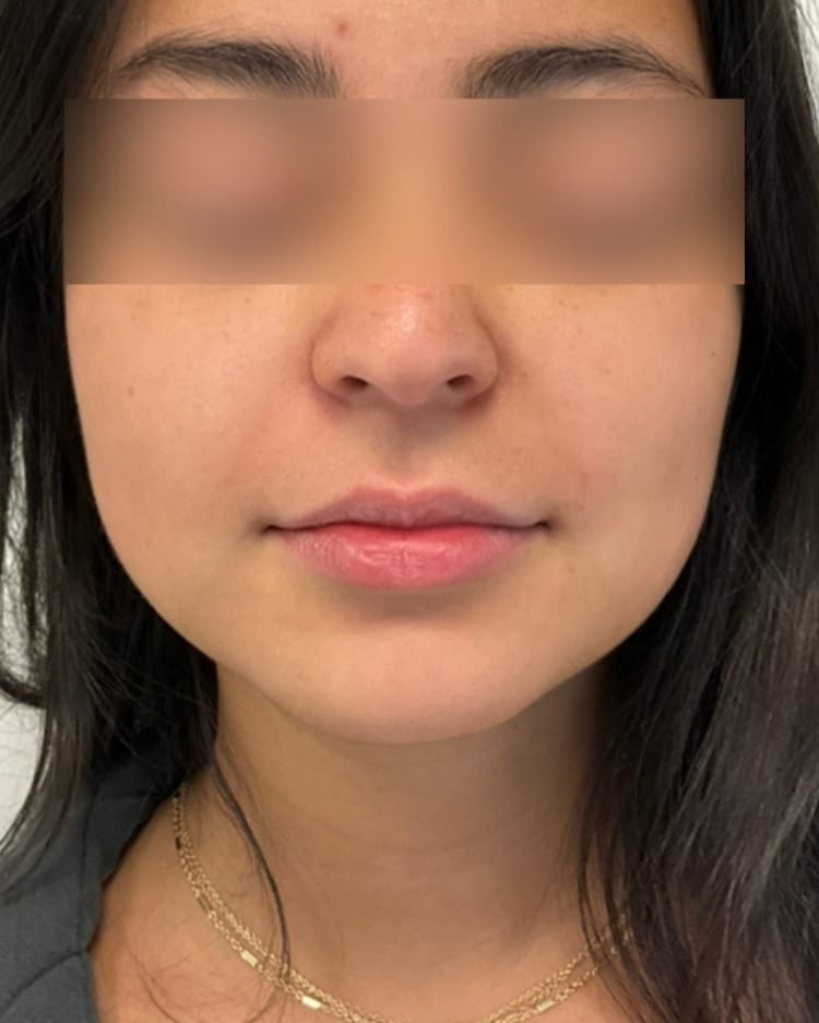 Lip filler before photo of CSPS patient — thin lips — Brentwood TN