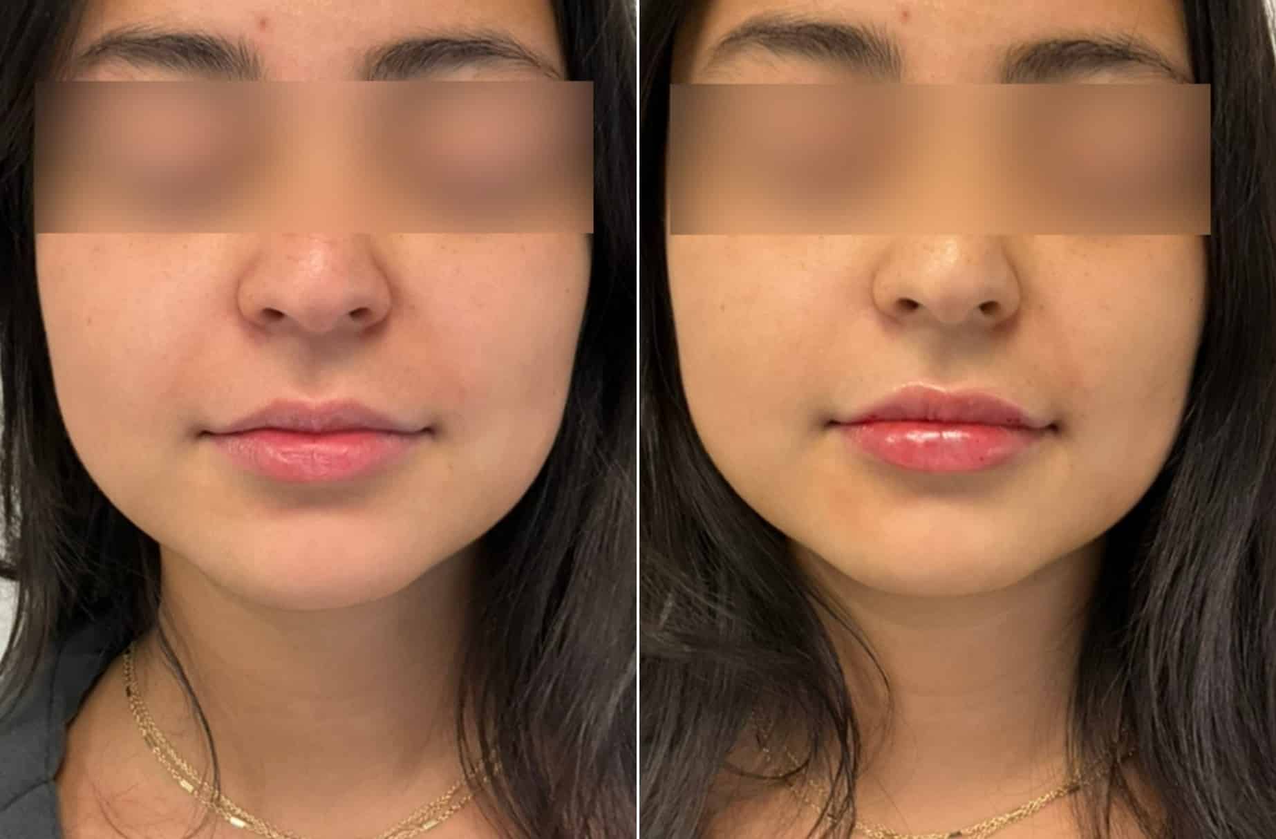 Lip filler before and after photos — CSPS patient with Laura Sonn, RN — Brentwood TN