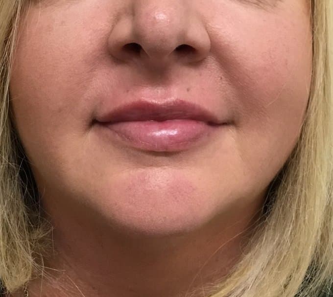 Lip filler after photo, lower-face view — Case 88, Cool Springs Plastic Surgery, Brentwood TN