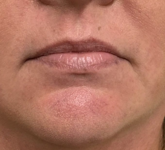 Lip filler before photo, lower-face view — Case 88, Cool Springs Plastic Surgery, Brentwood TN