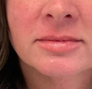 Lip filler after photo — Susan Vickers, Case 104, Cool Springs Plastic Surgery, Brentwood TN