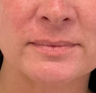 Lip filler before photo — Susan Vickers, Case 104, Cool Springs Plastic Surgery, Brentwood TN