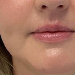Lip filler after photo — Susan Vickers, Case 119, Cool Springs Plastic Surgery, Brentwood TN