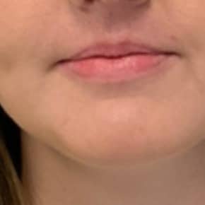 Lip filler before photo — Susan Vickers, Case 119, Cool Springs Plastic Surgery, Brentwood TN