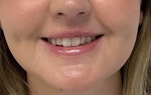 Lip filler after photo, smiling view — Case 119, Cool Springs Plastic Surgery, Brentwood TN