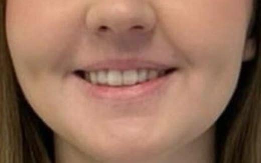 Lip filler before photo, smiling view — Case 119, Cool Springs Plastic Surgery, Brentwood TN