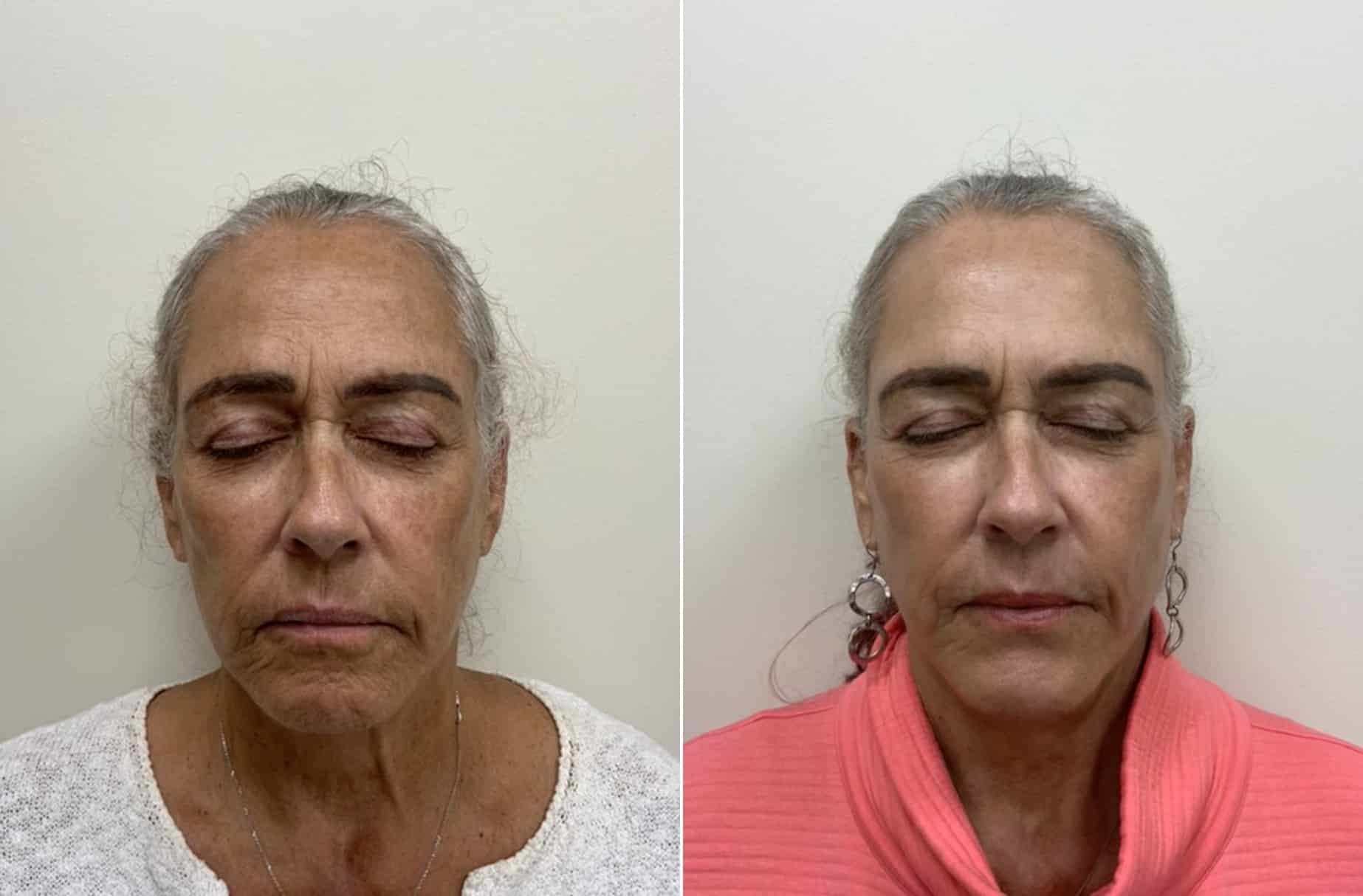 Moxi laser before and after photos — CSPS patient with Destiny Berger, LE — Brentwood TN