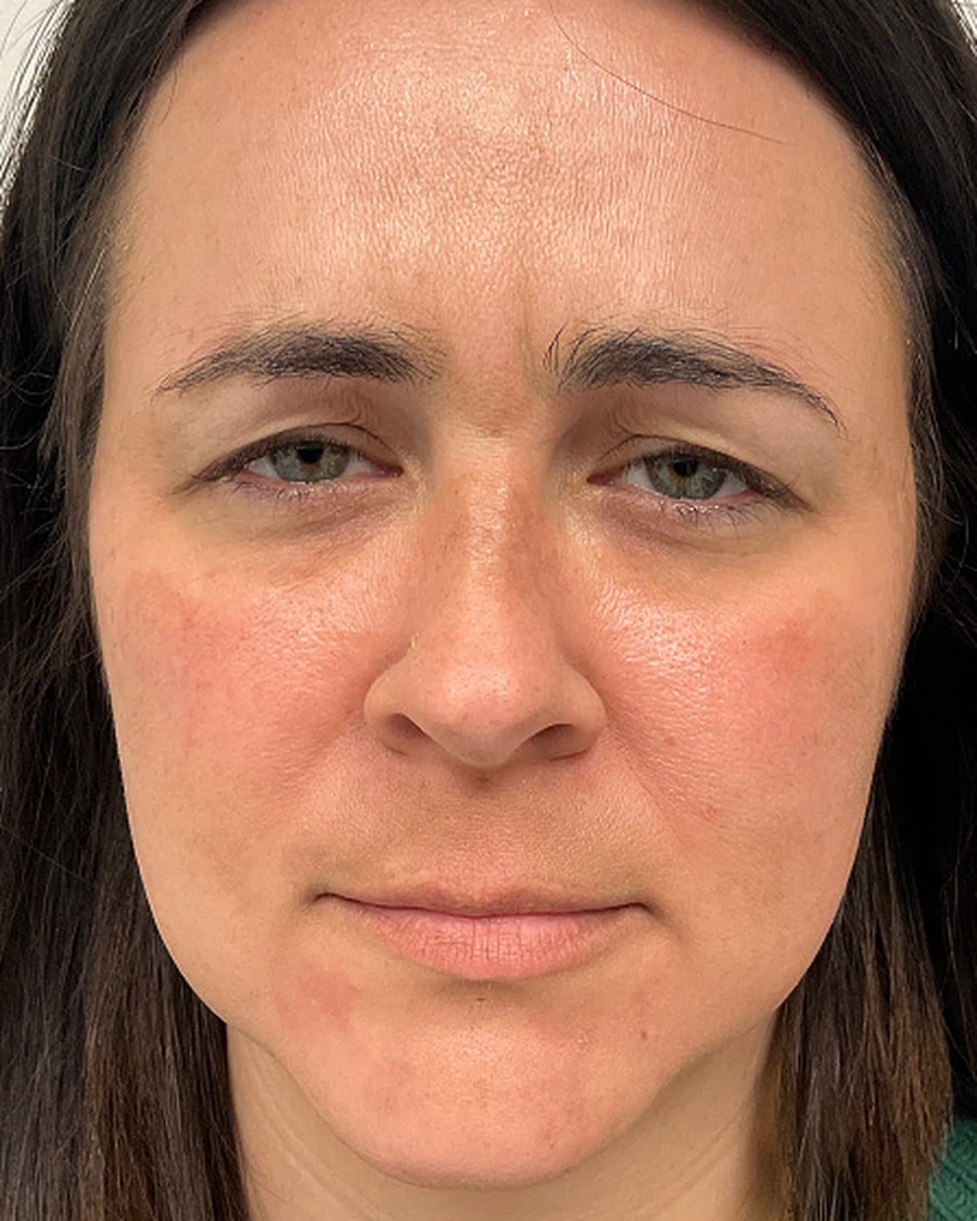 Medical-grade skincare after photo, even skin tone — Chrissy Handly, Case 61, Cool Springs Plastic Surgery, Brentwood TN