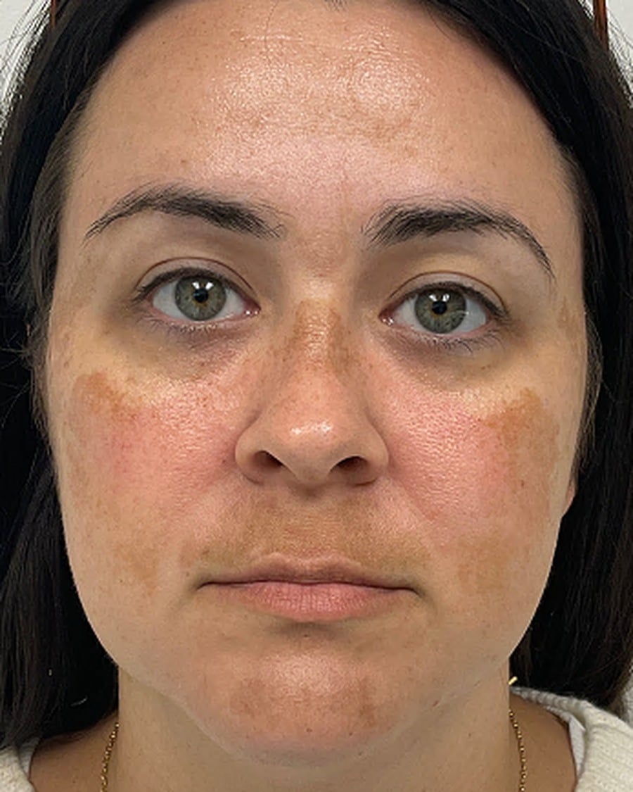Medical-grade skincare before photo, melasma — Chrissy Handly, Case 61, Cool Springs Plastic Surgery, Brentwood TN