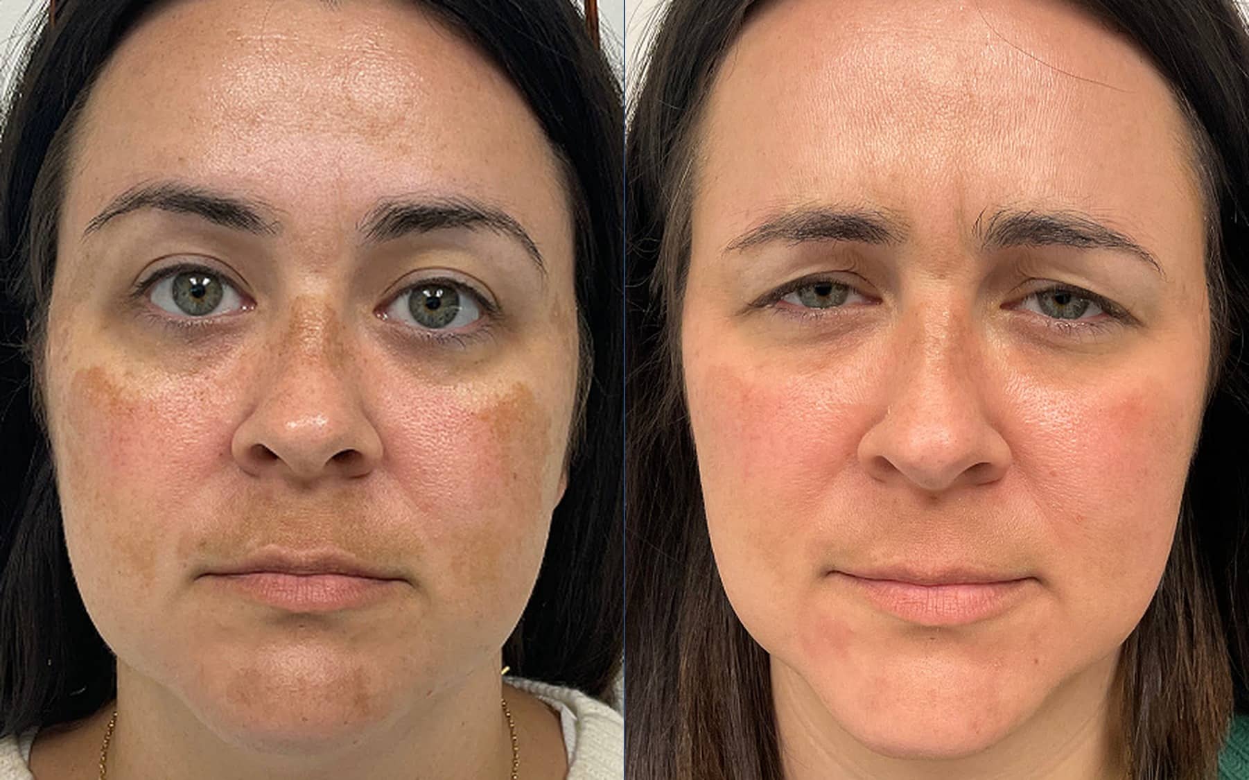 Medical-grade skincare before and after, melasma — Chrissy Handly, Case 61, Cool Springs Plastic Surgery