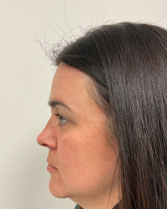 Medical-grade skincare after photo (side view) — Chrissy Handly, Case 61, Cool Springs Plastic Surgery, Brentwood TN