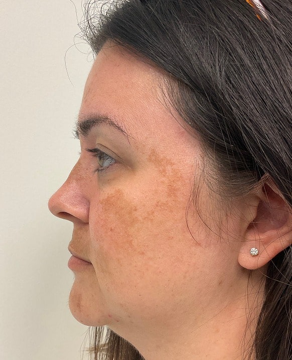 Medical-grade skincare before photo (side view) — Chrissy Handly, Case 61, Cool Springs Plastic Surgery, Brentwood TN