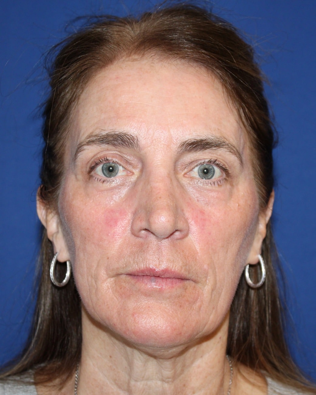 After TRL full-face laser skin resurfacing at Cool Springs Plastic Surgery in Nashville