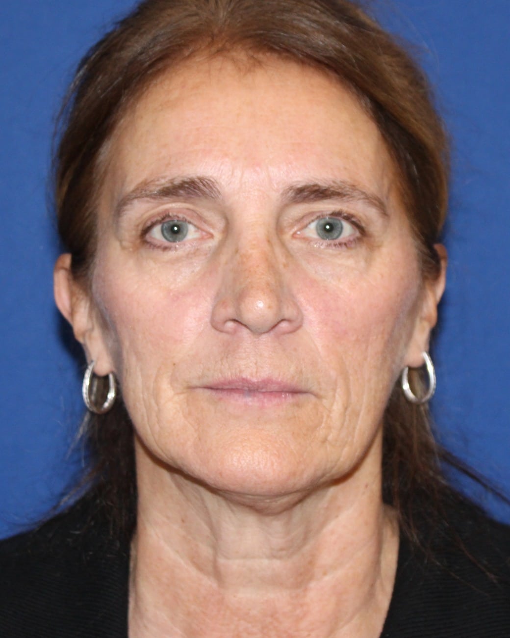 Before TRL full-face laser skin resurfacing at Cool Springs Plastic Surgery in Nashville